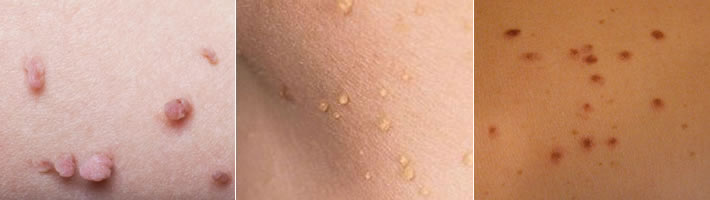 Skin Tag Removal, Sun Spot Removals Grotton
