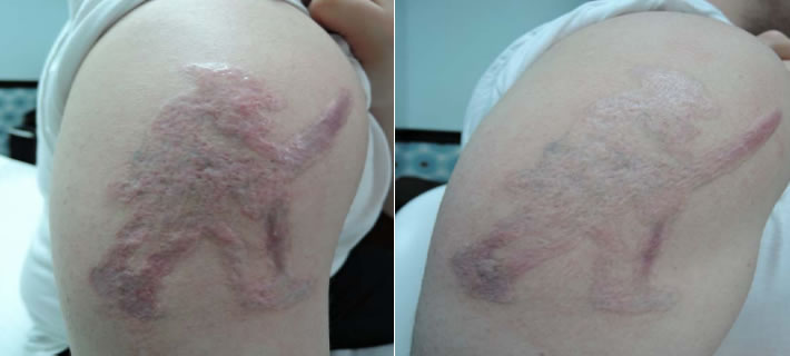 Innopen -Severe burns and scars after tattoo removal Bolton
