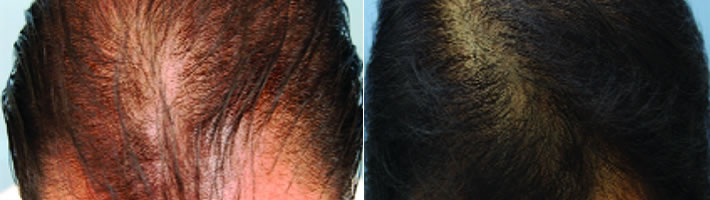 PRP - Hair Growth Mossley